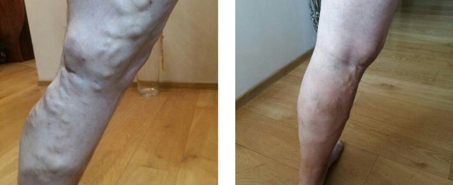 Pan Tomasz dzięki Su Dżok wyleczył żylaki!